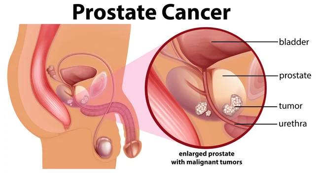 What You Need to Know About Prostate Cancer